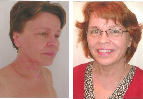 Eczema Before and After Acupuncture and Chinese Herbal Medicine at AcuMedic Centre