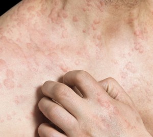 impetigo chinese herbal medicine acupuncture tcm north west london camden