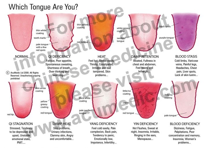 tongue_chart_camden_acumedic_tcm_london AcuMedic Clinic