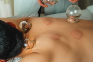 Chinese cupping therapy